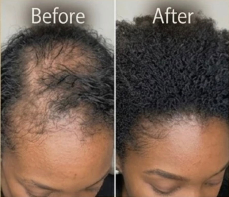 True Roots of Eden™ Hair Growth Oil – Alopecia & Edge Repair